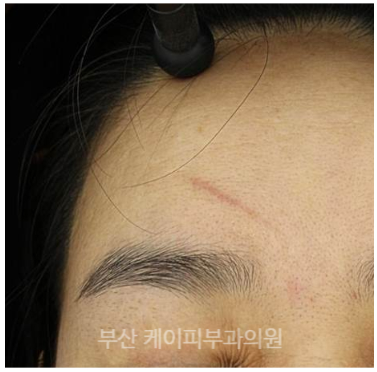 이마에 긁힌 자국 레이저 흉터치료_04.jpg