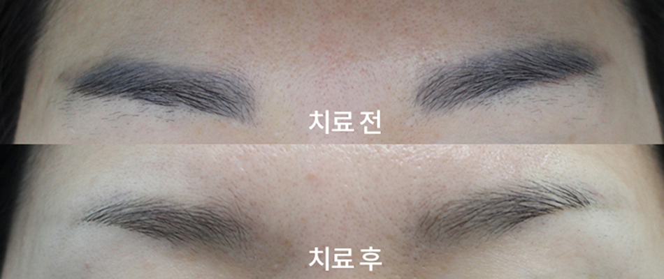 부산 눈썹문신제거_06.jpg