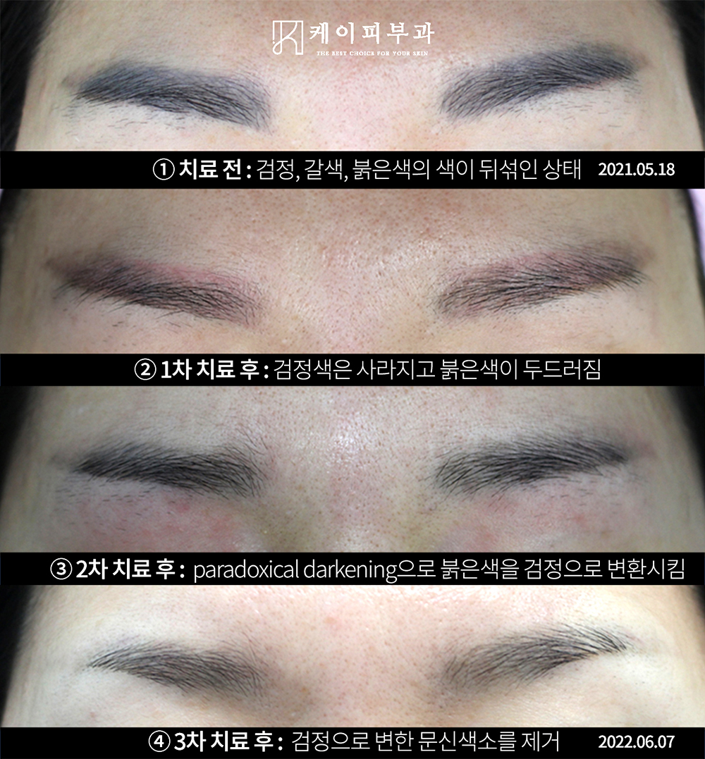 부산 눈썹문신제거_07.jpg