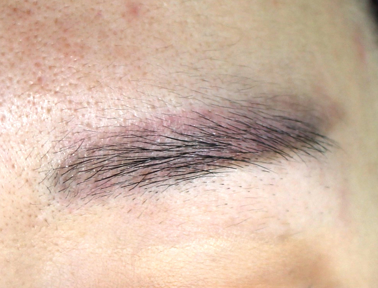 부산 눈썹문신제거_05.jpg