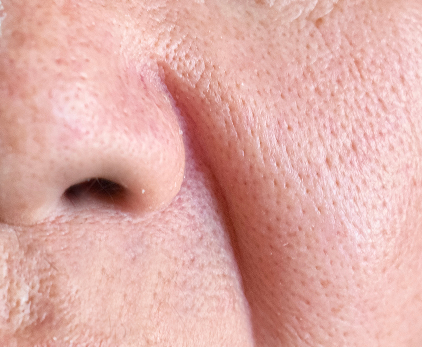 부산 팔자주름 리프팅 레이저_02.jpg