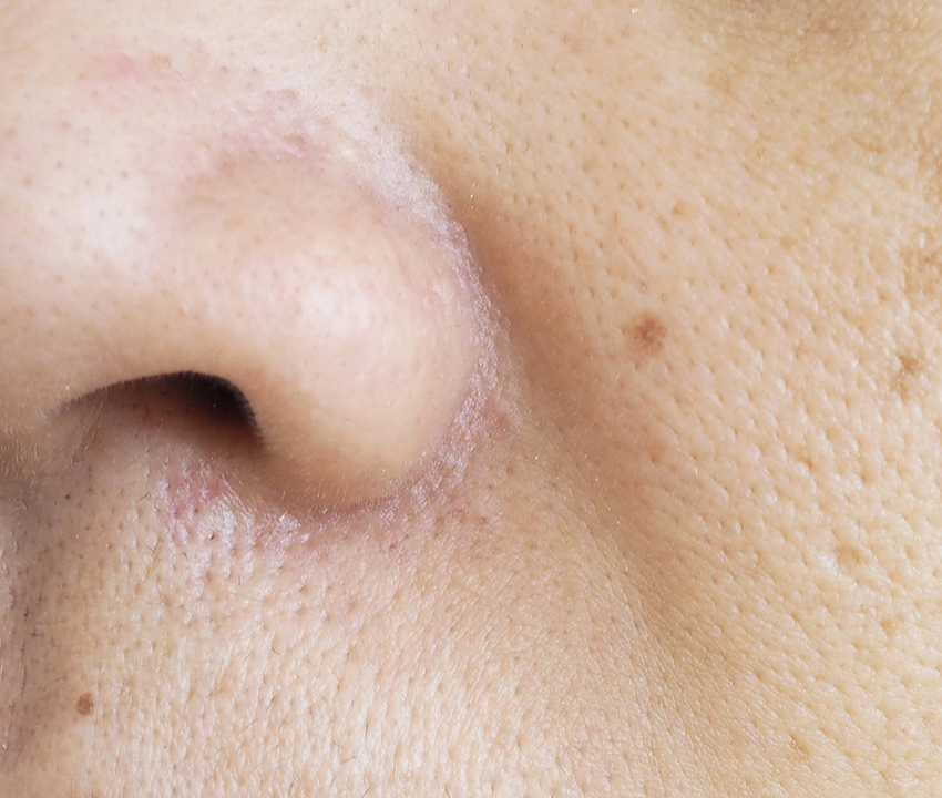 부산 팔자주름 리프팅 레이저_01.jpg