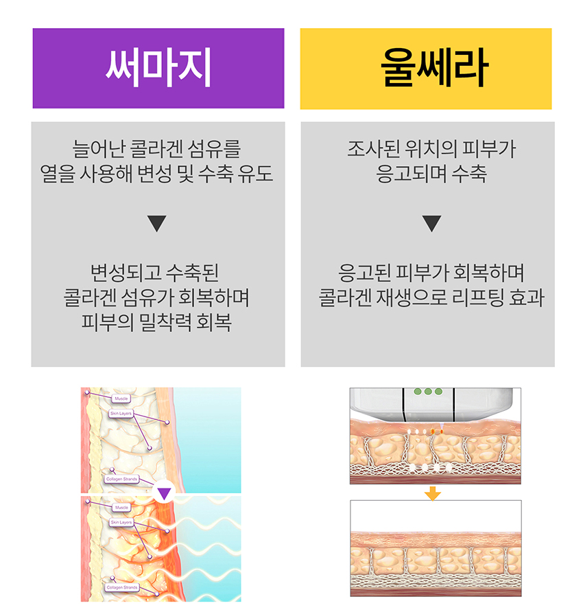 부산 팔자주름 리프팅 레이저_11.jpg