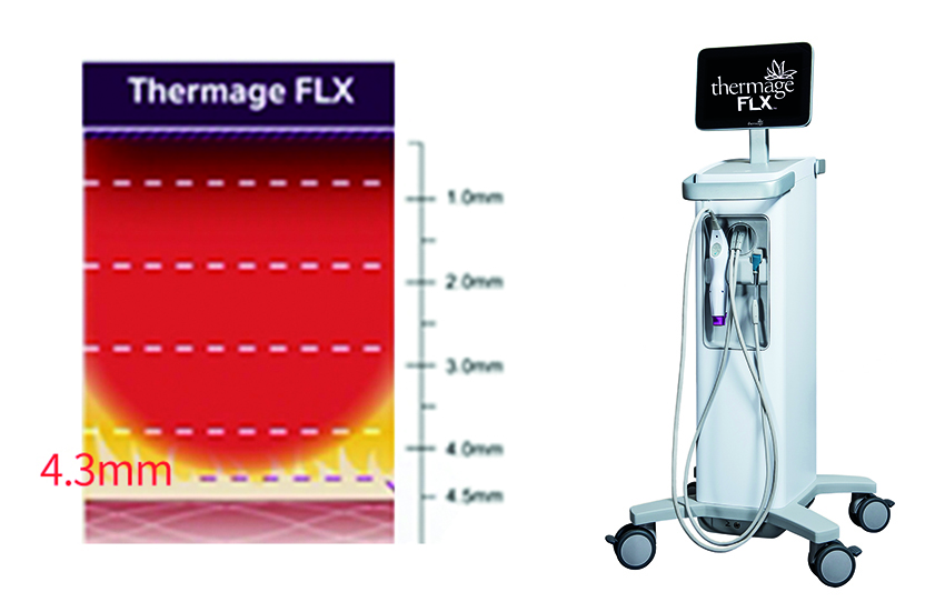 부산 팔자주름 리프팅 레이저_06.jpg