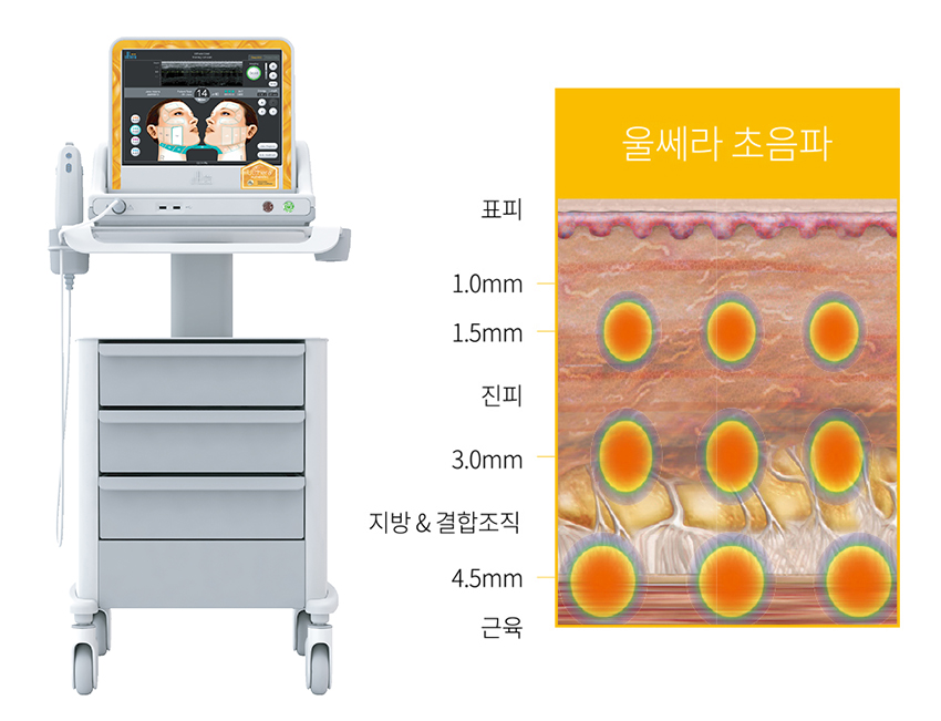 부산 팔자주름 리프팅 레이저_04.jpg