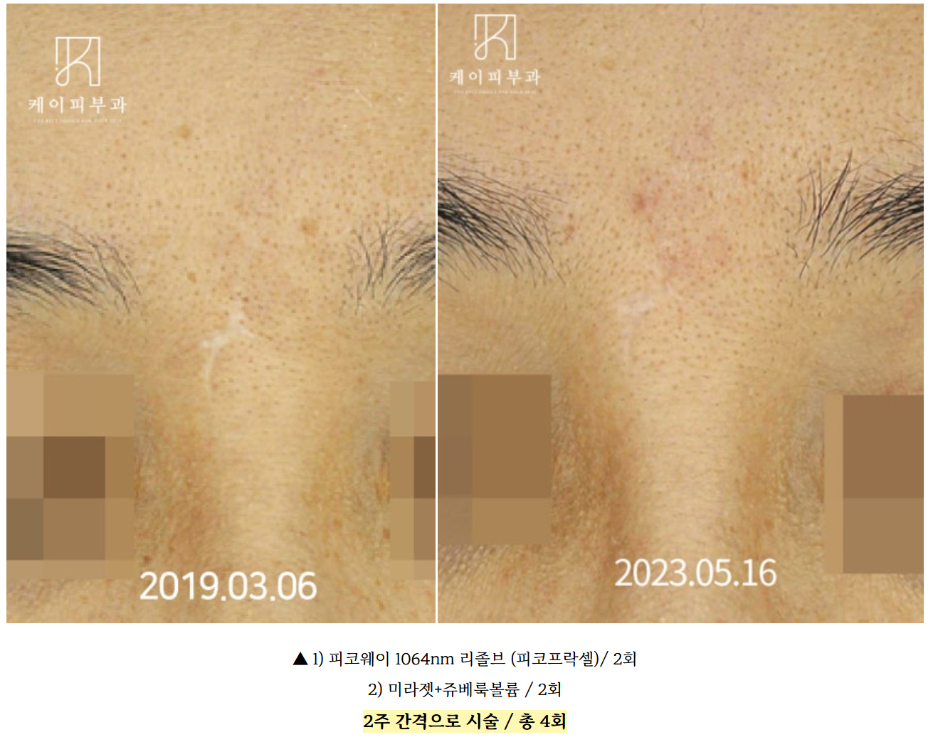 부산 흉터치료 후기_01.jpg