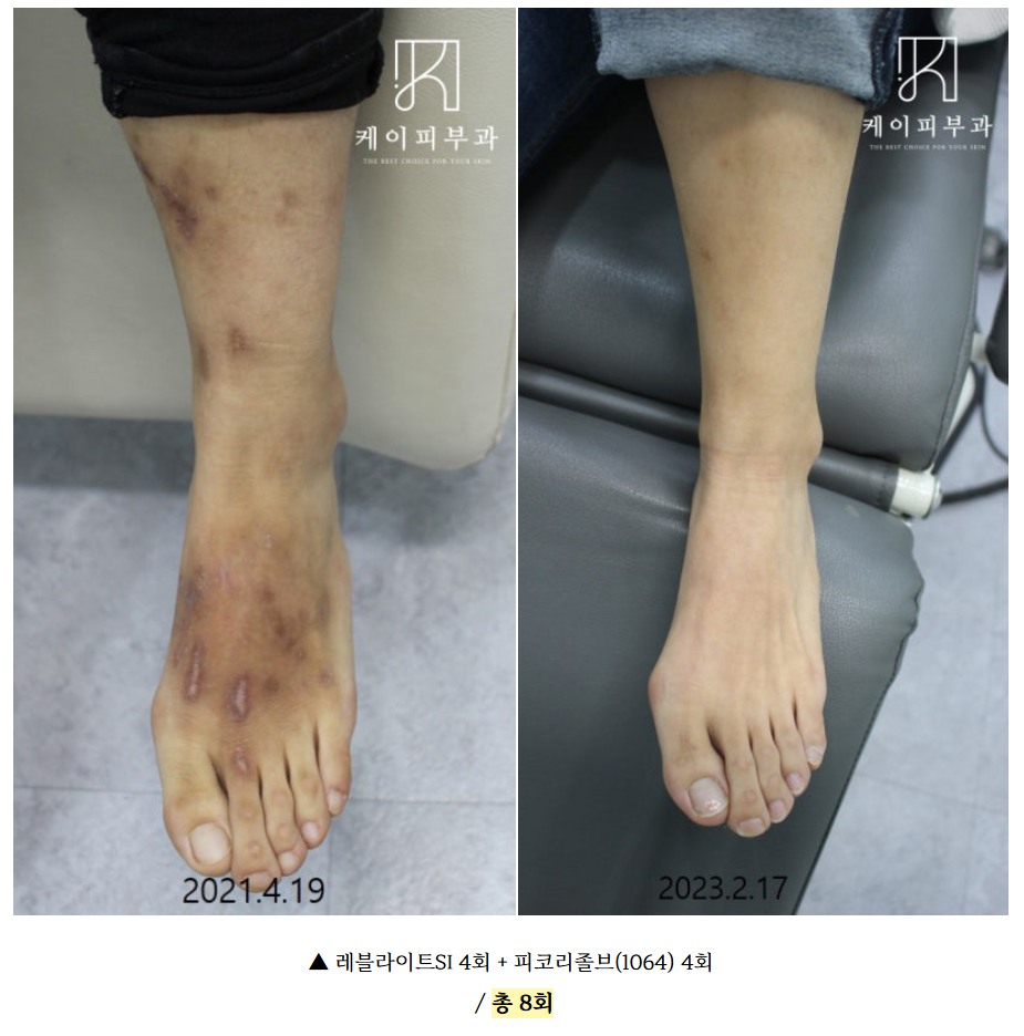 부산 흉터치료 후기_02.jpg