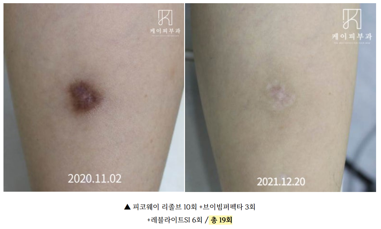 부산 흉터치료 후기_03.jpg