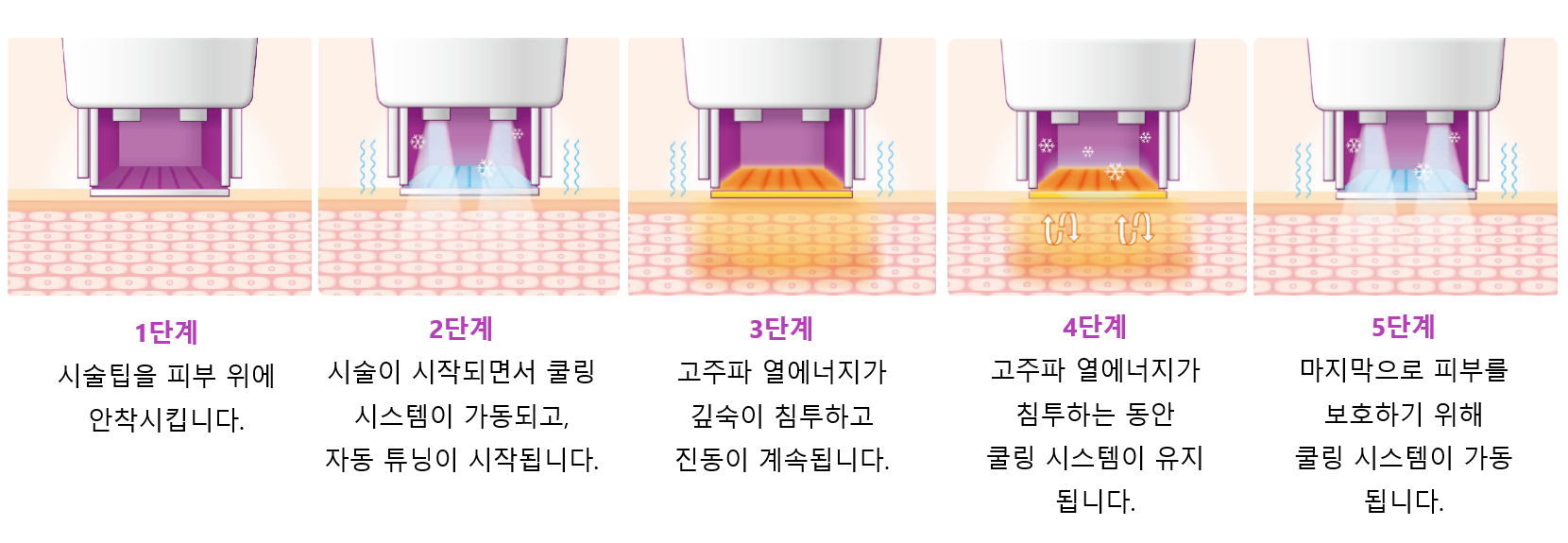 써마지_원리.png