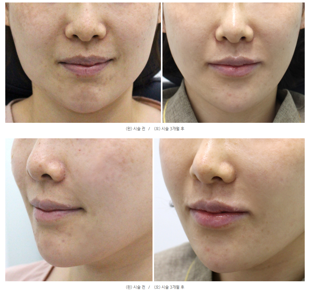 부산 울쎄라 리프팅_04.jpg