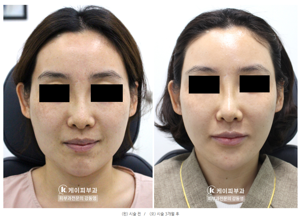 부산 울쎄라 리프팅_02.jpg