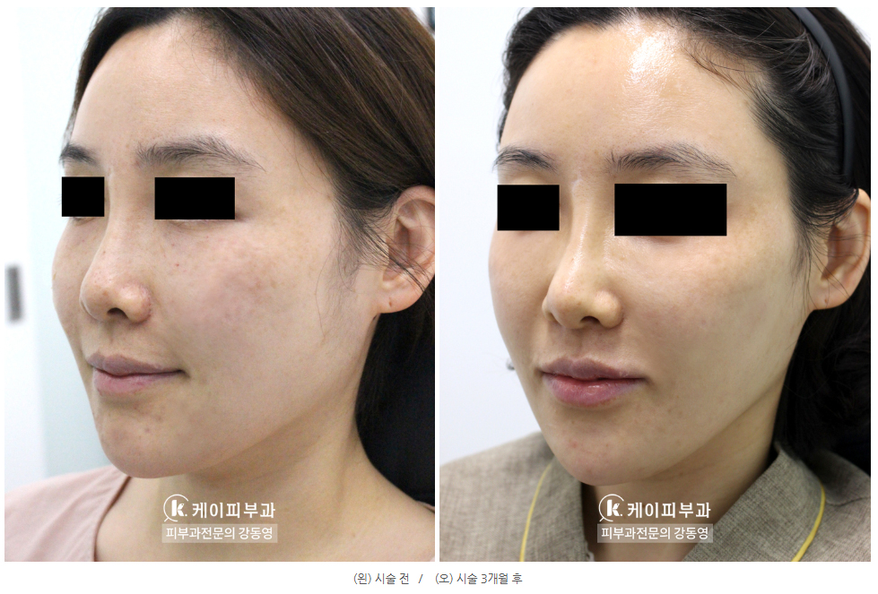 부산 울쎄라 리프팅_03.jpg