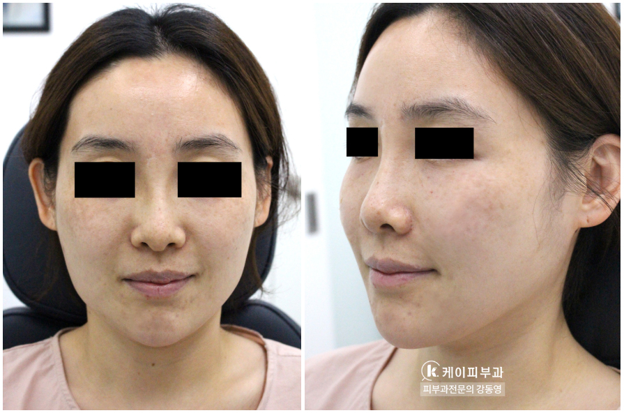 부산 울쎄라 리프팅_01.jpg